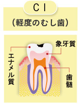 軽度のむし歯