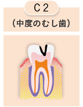 中度のむし歯