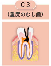 重度のむし歯