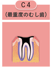 最重度のむし歯