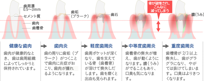 歯周病の症状と進行